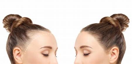 Expert Alopecia and Hair Loss Treatments in Dubai at Cosmocare Medical Center