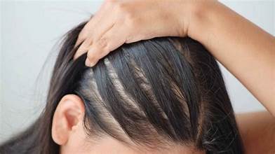 Expert Alopecia and Hair Loss Treatments in Dubai at Cosmocare Medical Center