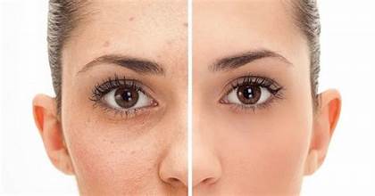 Facial Wart Removal Specialist in Dubai at Cosmocare Medical Center