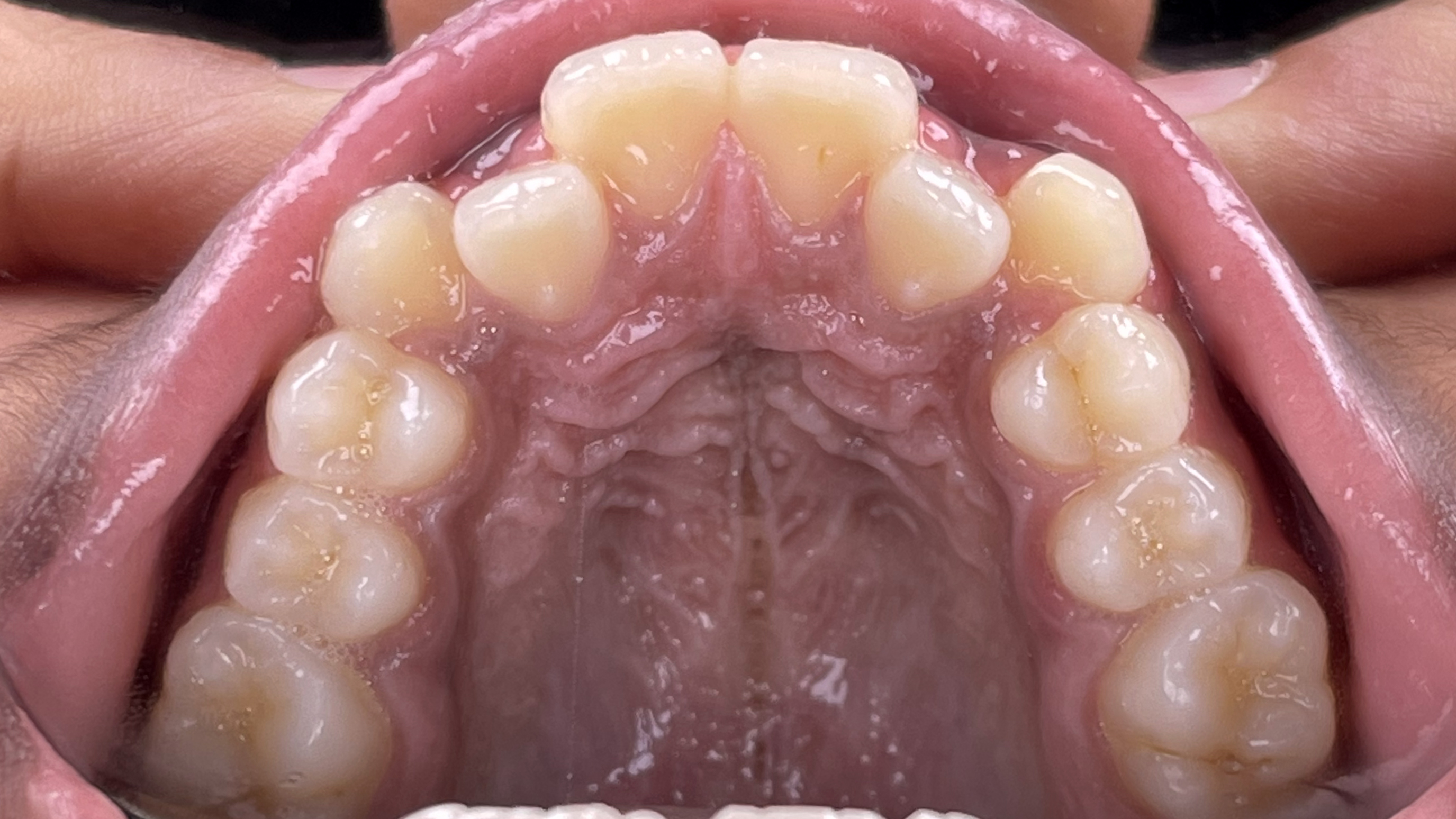 Alignment of crooked teeth