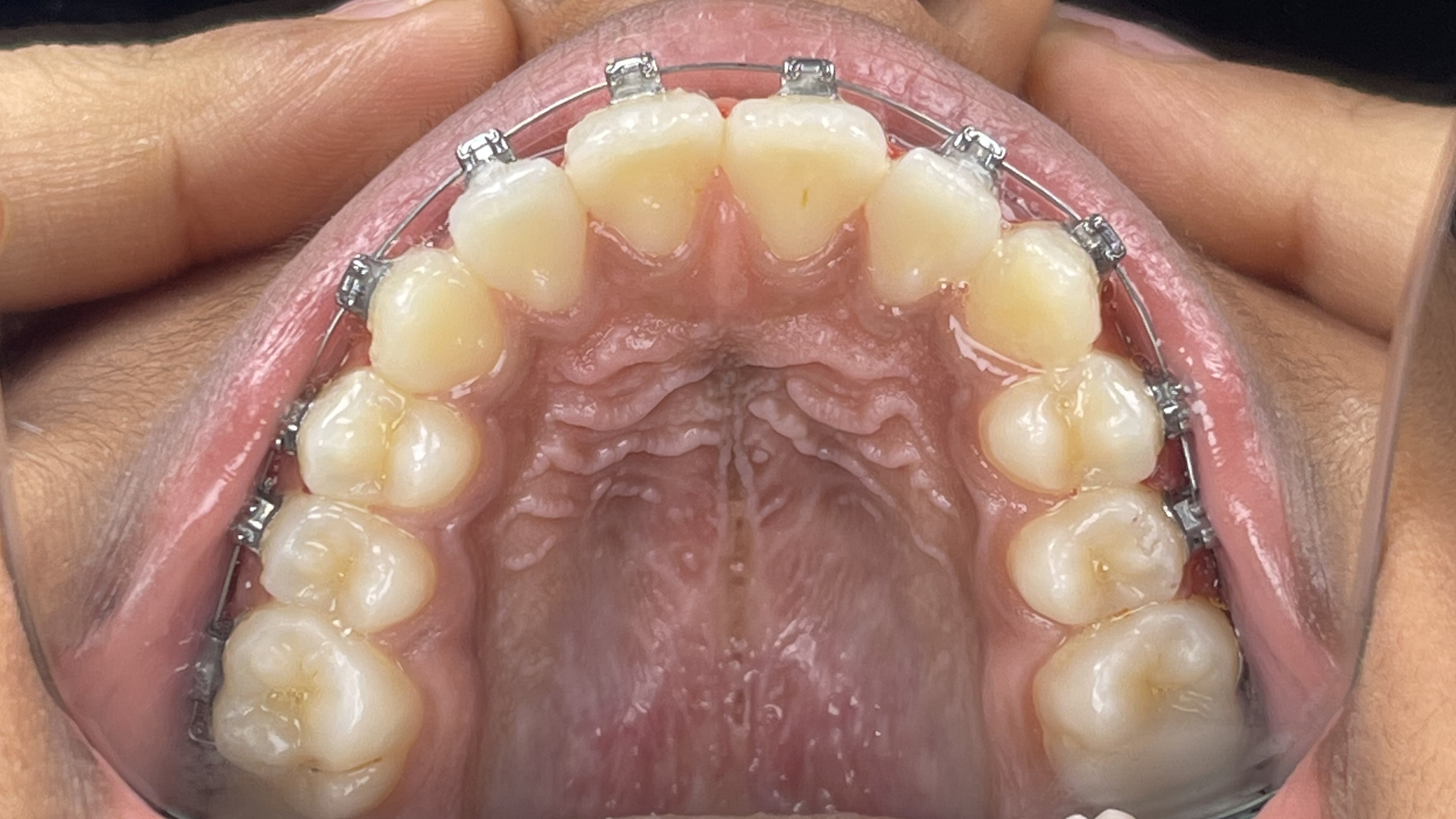 Alignment of crooked teeth