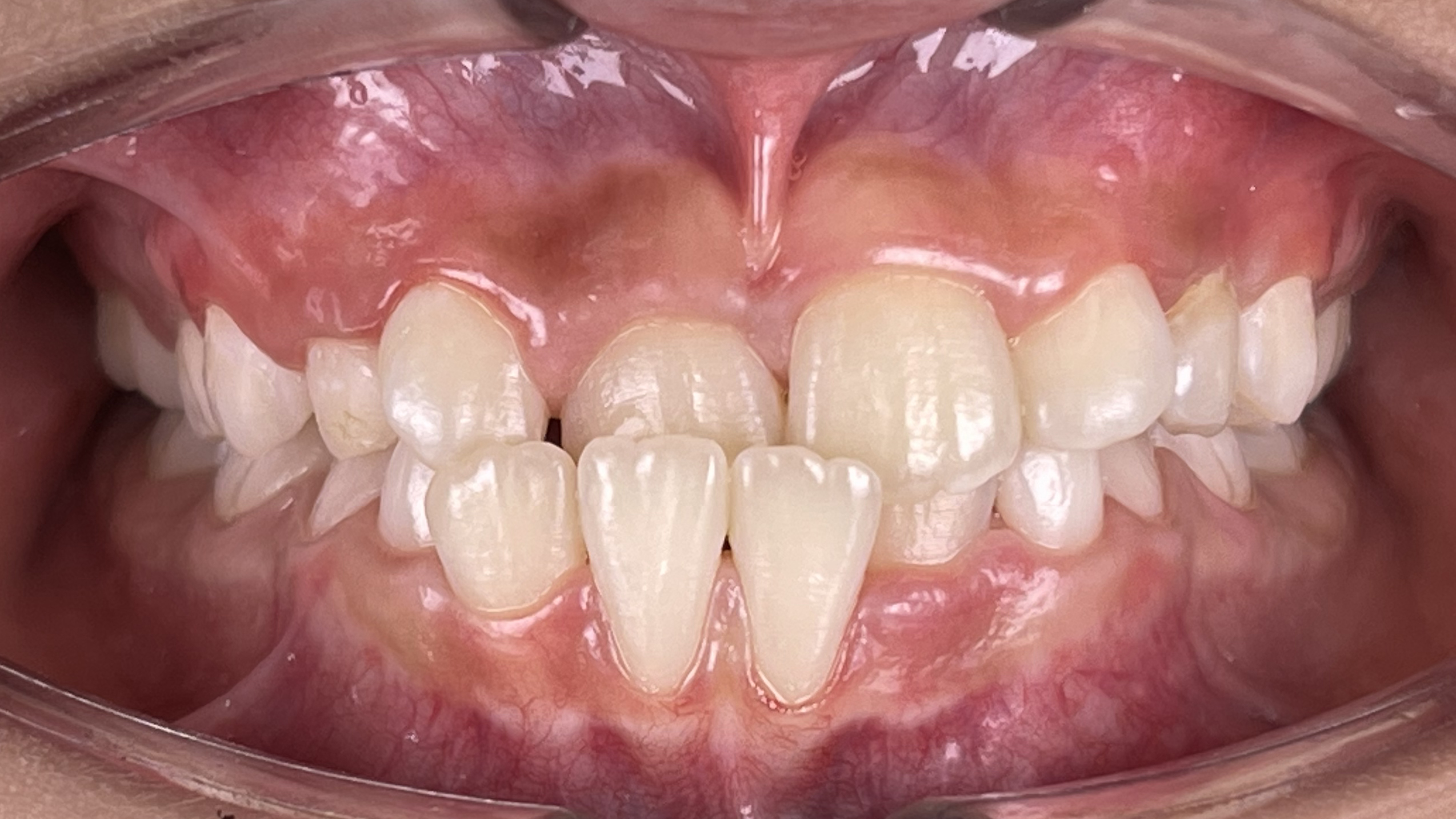 Correction of deepbite,openbite and underbite