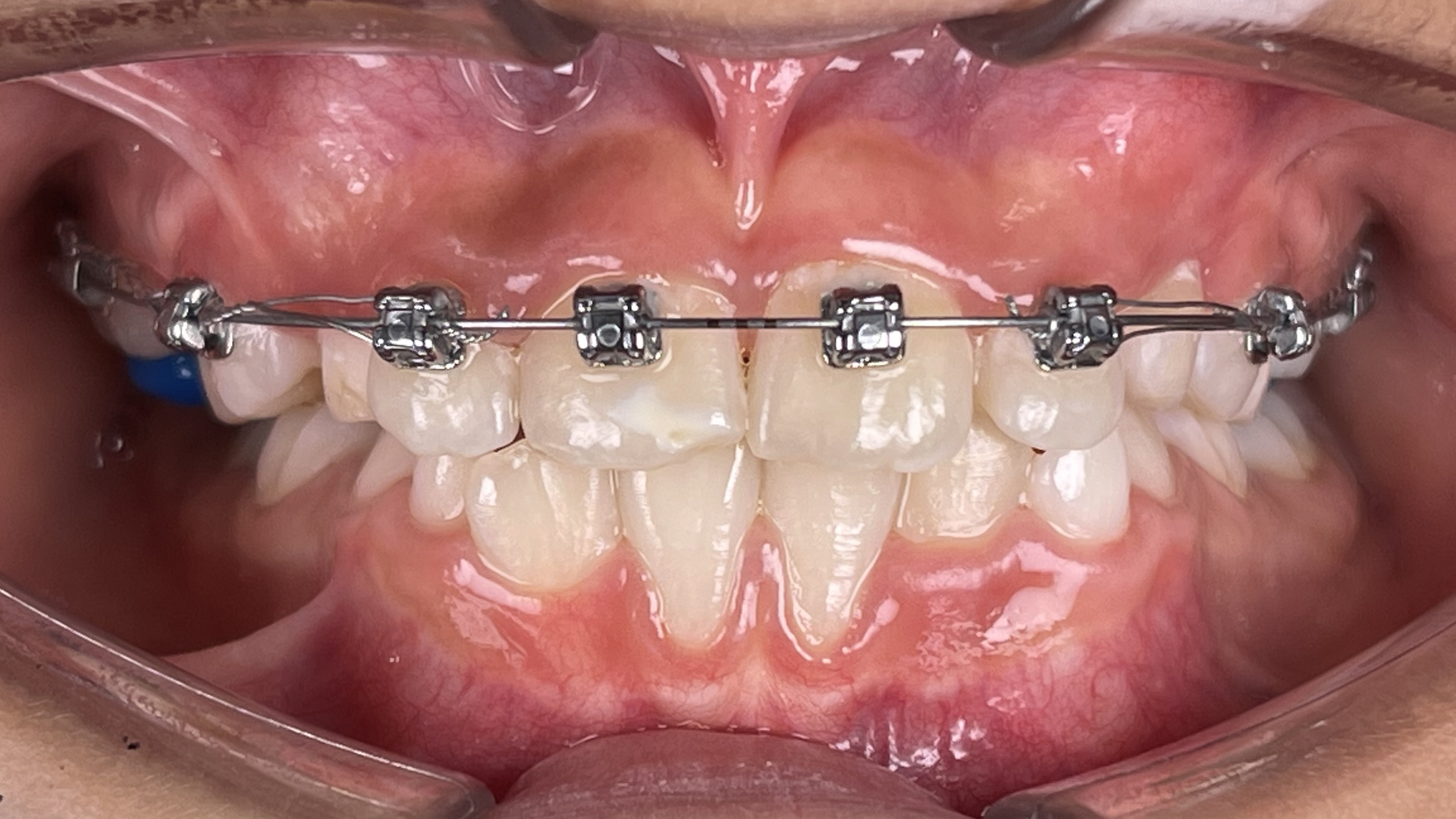 Correction of deepbite,openbite and underbite