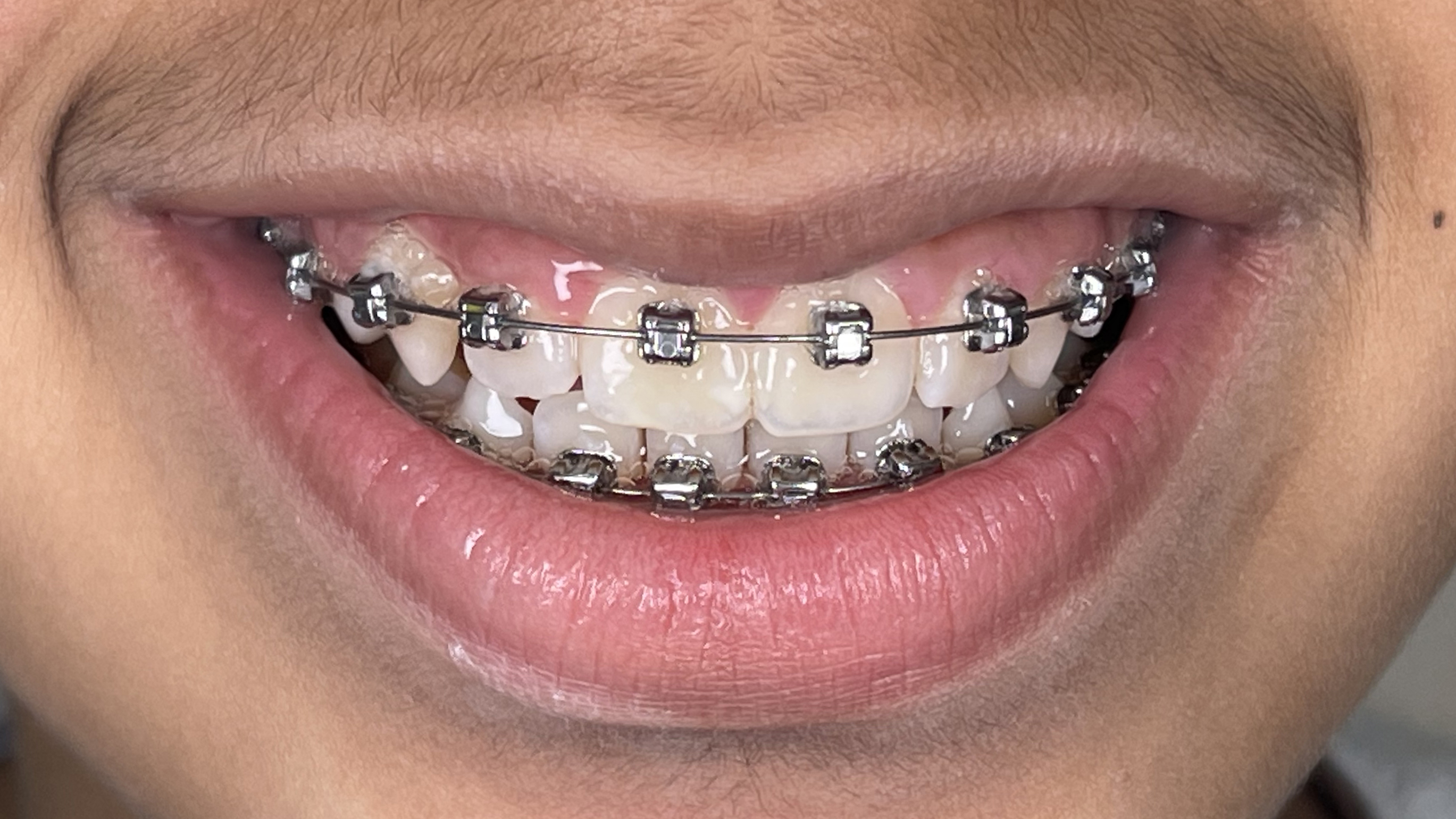 Correction of jaw protrusion
