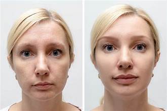 Botox Before After