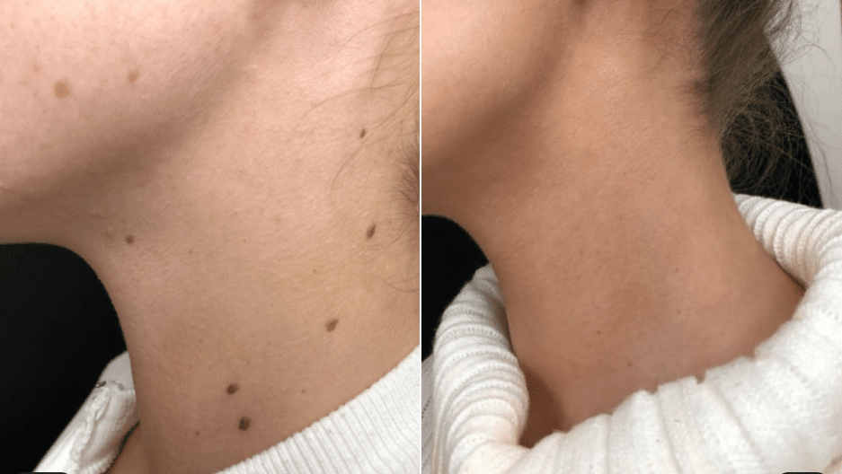 Mole Removal