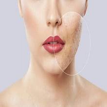 Large Pores Treatment in Dubai by Dr. Murtuza Bandukwala at Cosmocare Medical Center