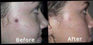 Laser Wart Removal Specialist in Dubai at Cosmocare Medical Center