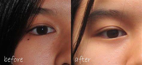 Expert Mole Removal Treatments in Dubai