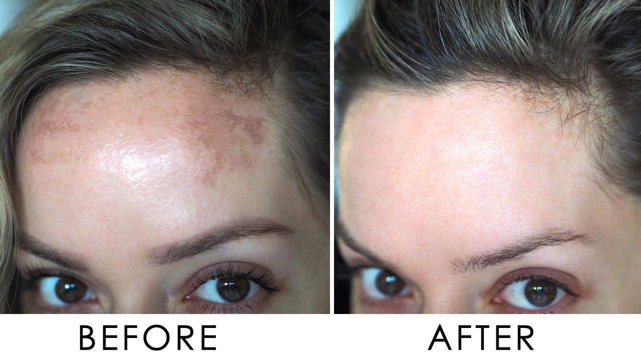 Pigmentation Skin Discoloration Treatment By Specialist Doctor In