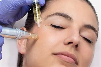 PRP treatment for cheeks in Dubai