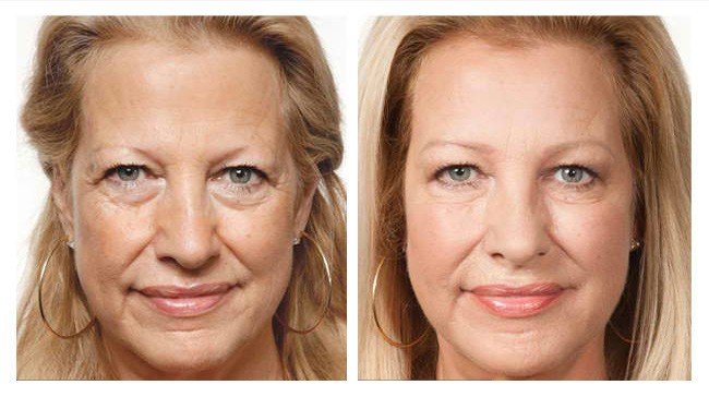 PRP treatment for cheeks in Dubai