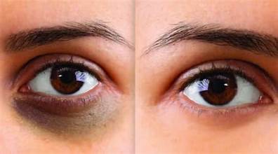 PRP treatment for dark circles in Dubai