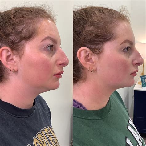 PRP treatment for nasolabial folds in Dubai