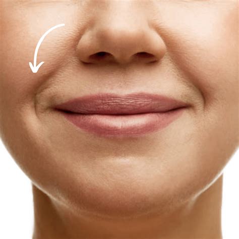 PRP treatment for nasolabial folds in Dubai