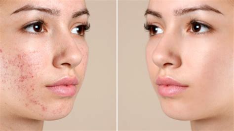 PRP treatment for acne scars in Dubai