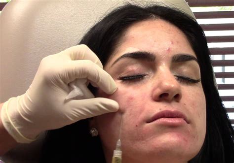 PRP treatment for acne scars in Dubai