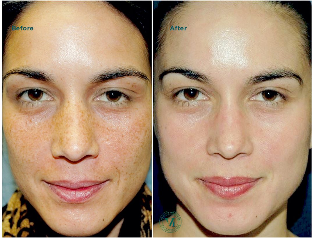 PRP treatment for sun damage in Dubai